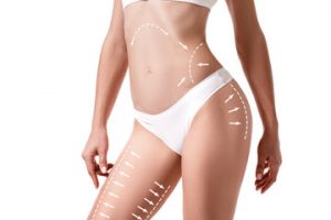 Liposuzione O Liposcultura A Milano